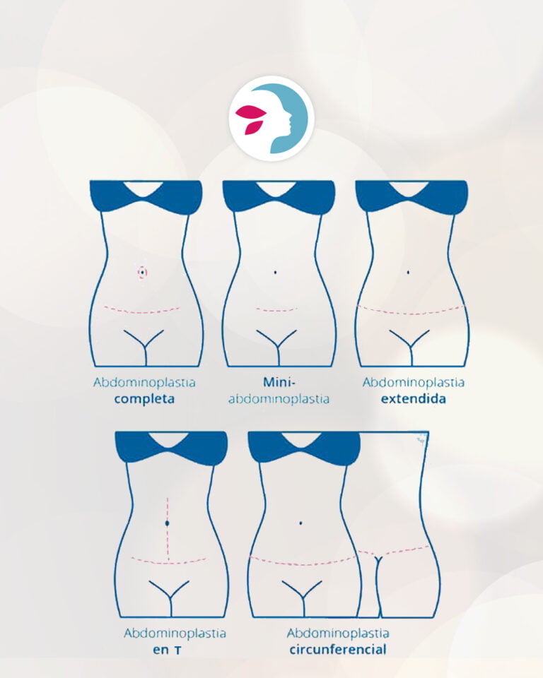 Cicatriz Abdominoplastia Hablemos De La Sana Cicatrizaci N