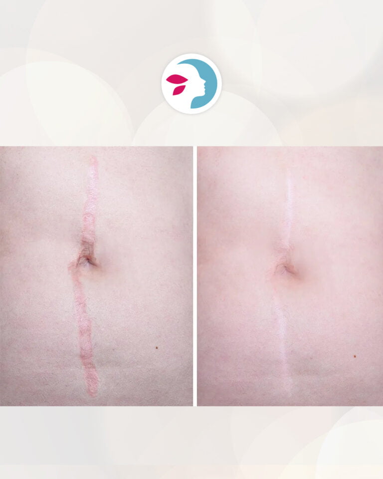 Evolucion Cicatriz Abdominoplastia