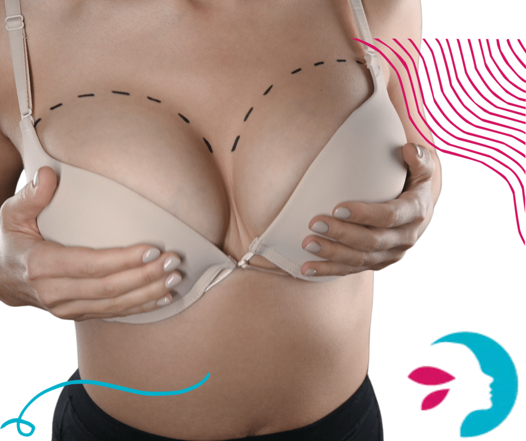 ¿Cuál es la edad ideal recomendada para una mastopexia? ¿Cuál es la edad ideal recomendada para una mastopexia