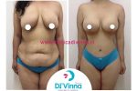 Maxoplastia 2