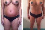 mastopexia 5